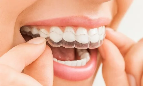 Invisalign Clear Aligner Invisalign Clear Aligner