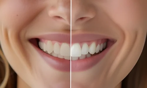 Teeth Whitening Teeth Whitening
