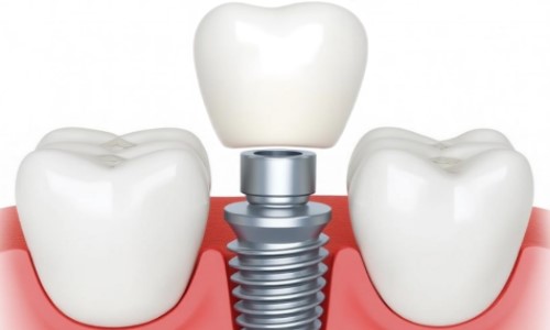 Dental Implants Dental Implants